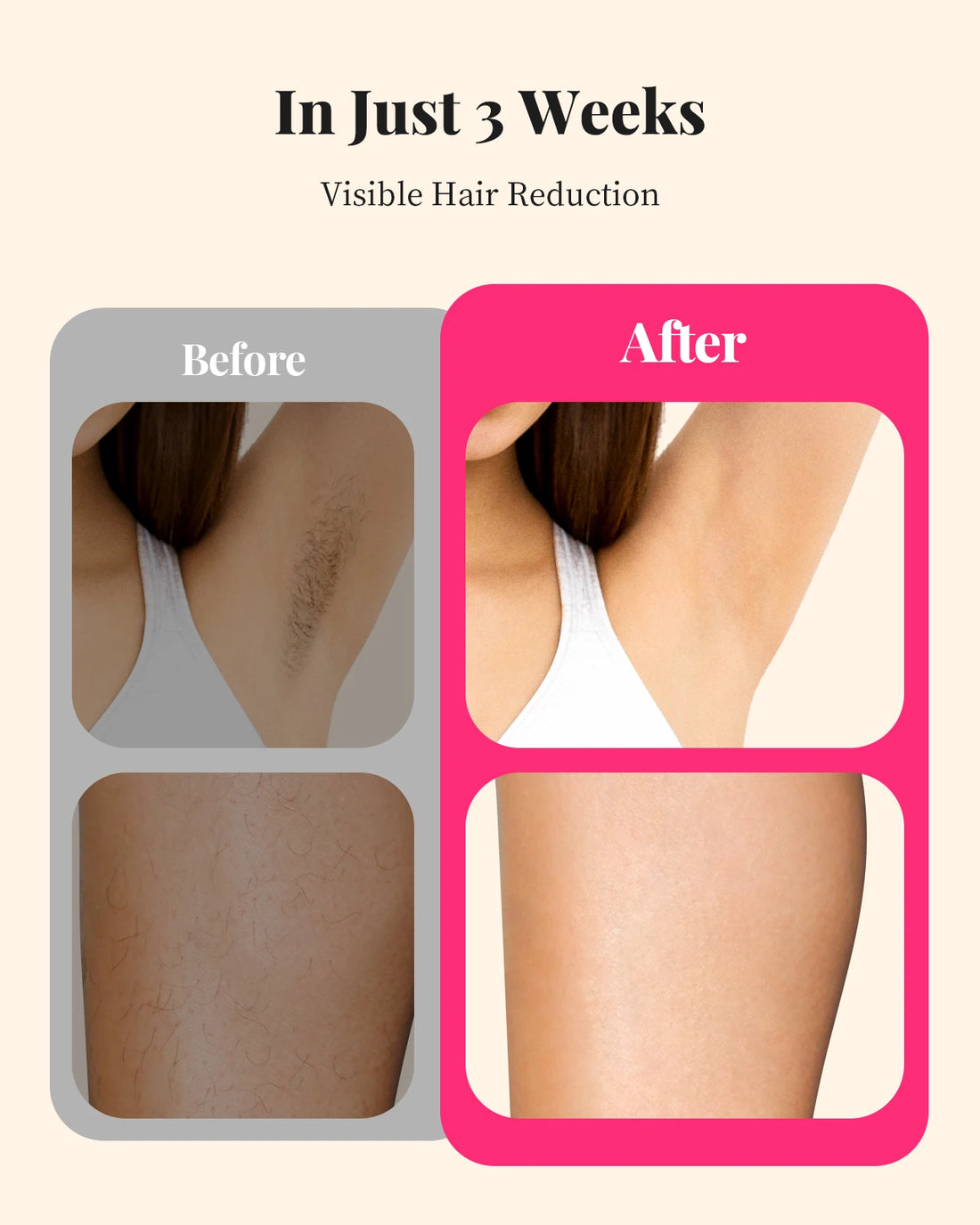 IPL Permanent Hair Removal Device – 990,000 Flashes, Painless Home Use