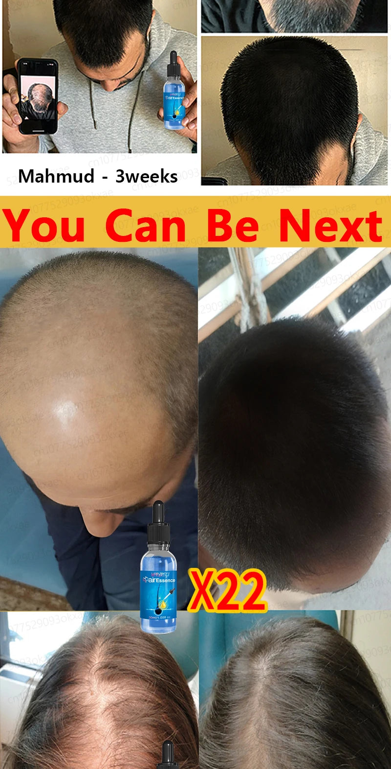 Baldness is no longer a concern. Grow thick, full hair with the help of this powerful formula.